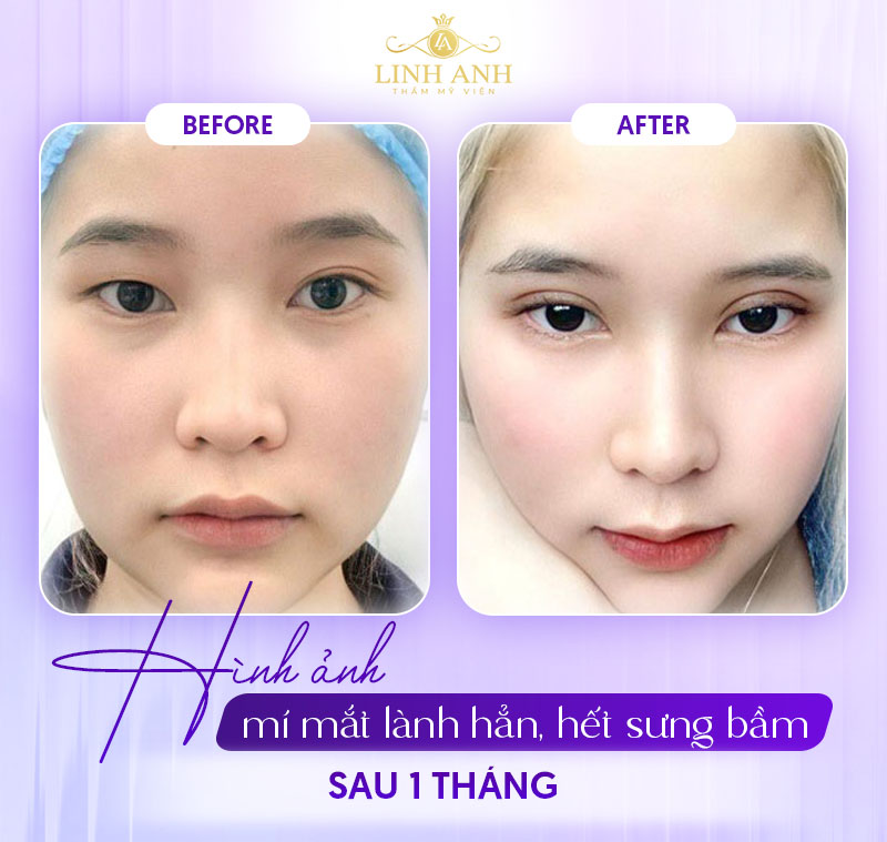 cắt mí sau 1 tháng cắt mí sau 1 tháng