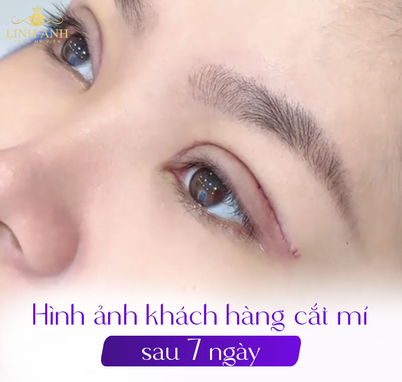 cắt mí sau 7 ngày sẽ như thế nào cắt mí sau 7 ngày sẽ như thế nào