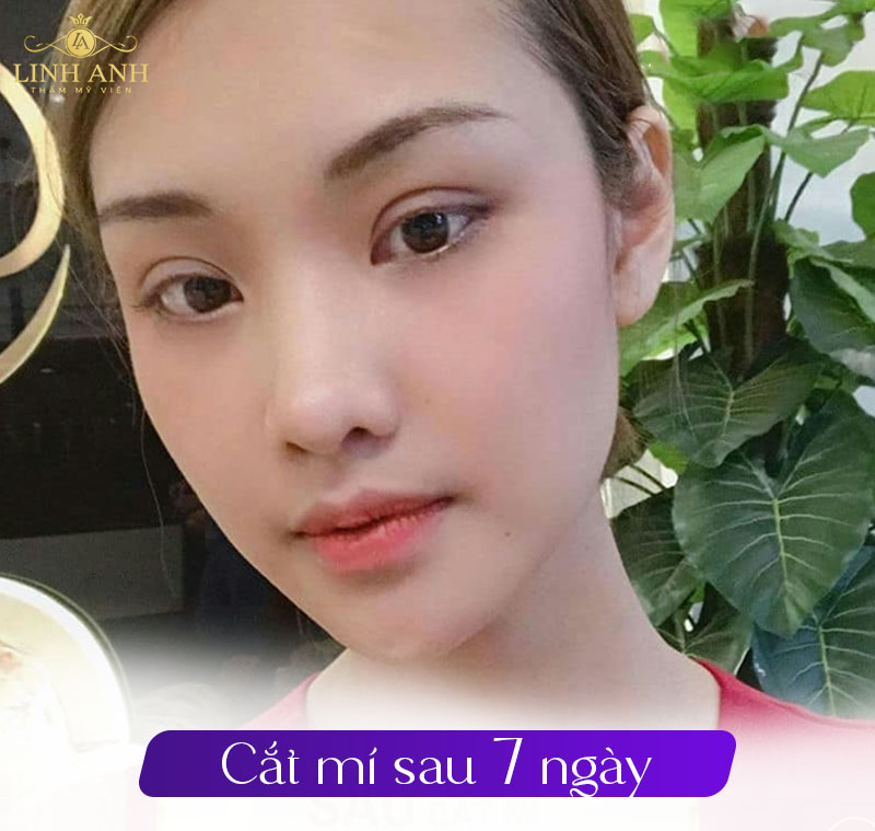 cắt mí sau 7 ngày cắt mí sau 7 ngày