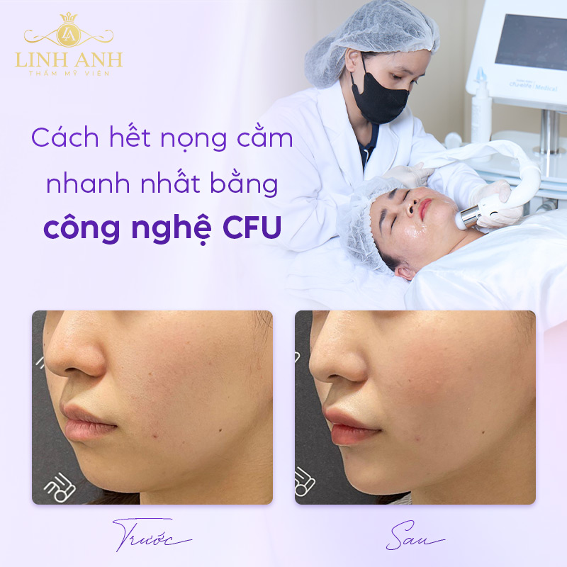 Công nghệ CFU xử lý nọng cằm