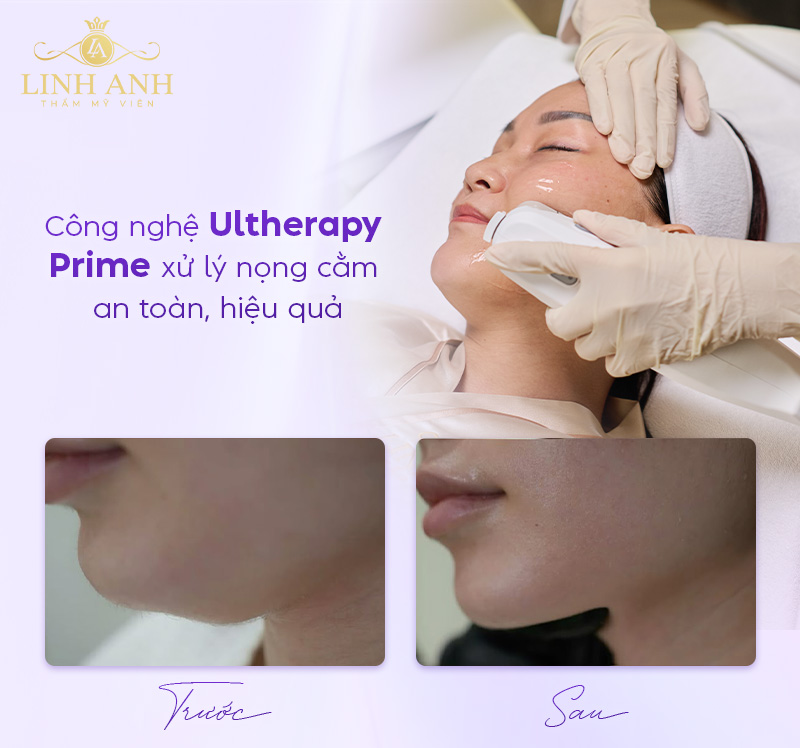 Công nghệ Ultherapy Prime