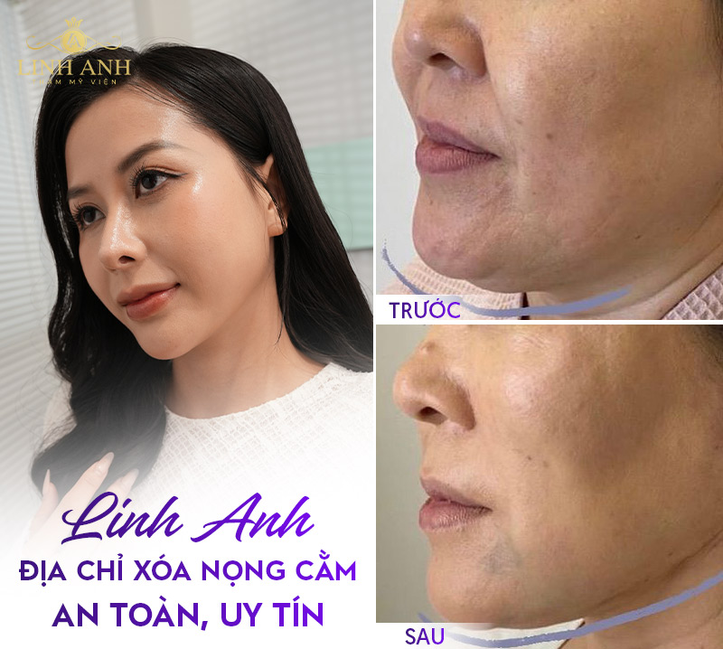 Địa chỉ xóa nọng cằm uy tín