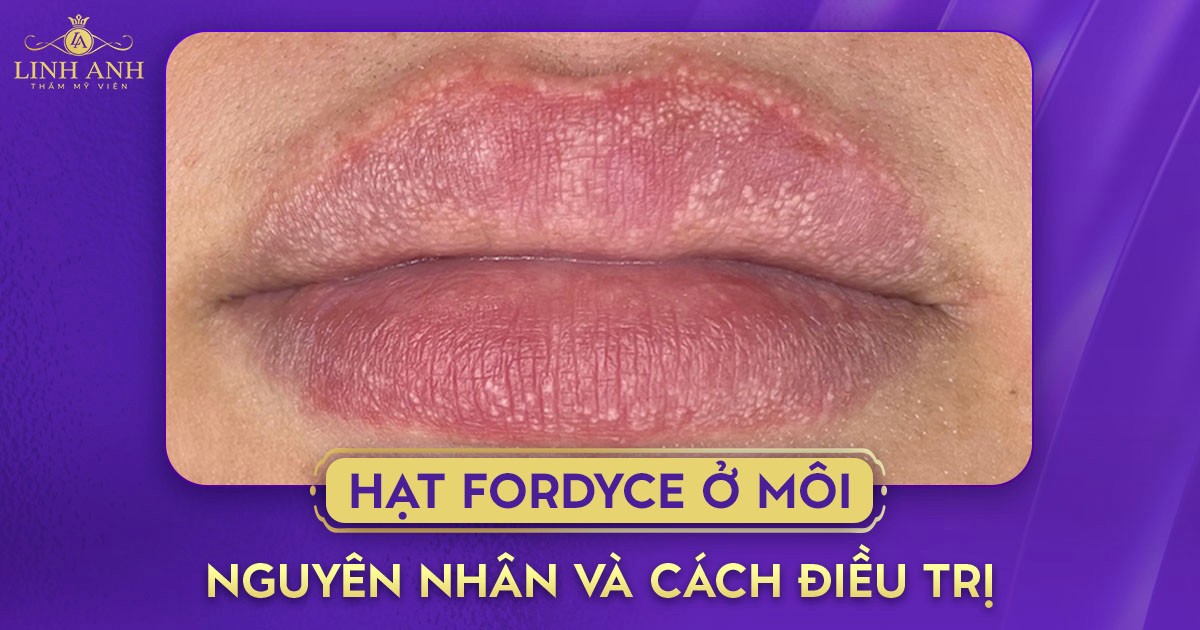 Hạt Fordyce ở môi: Nguyên nhân, cách nhận biết và điều trị