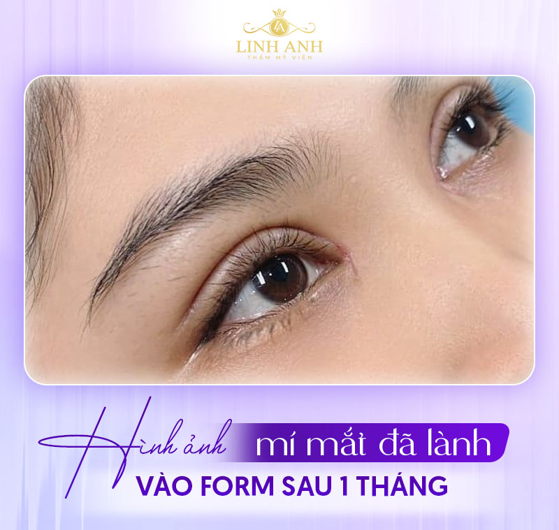 hình ảnh cắt mí 1 tháng hình ảnh cắt mí 1 tháng