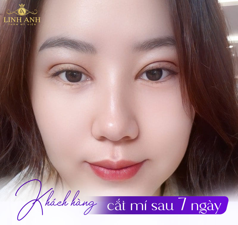 hình ảnh cắt mí 7 ngày hình ảnh cắt mí 7 ngày