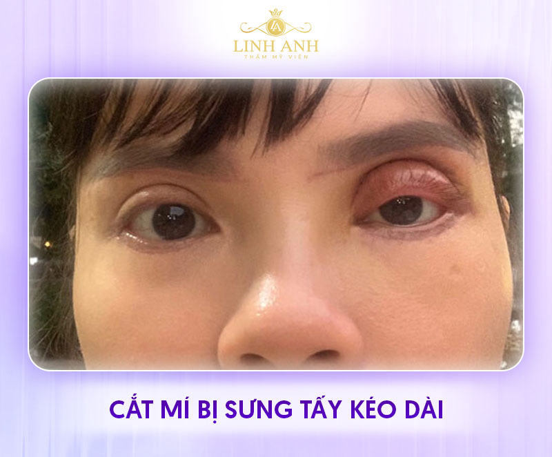 hình ảnh cắt mí mắt 1 tháng hình ảnh cắt mí mắt 1 tháng