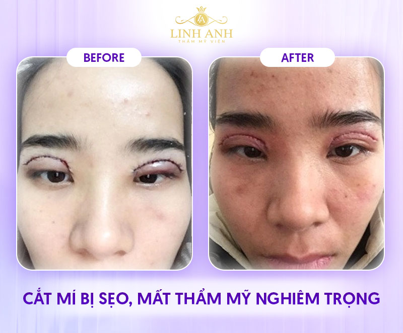 hình ảnh cắt mí mắt sau 1 tháng hình ảnh cắt mí mắt sau 1 tháng
