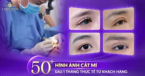 hình ảnh cắt mí sau 1 tháng