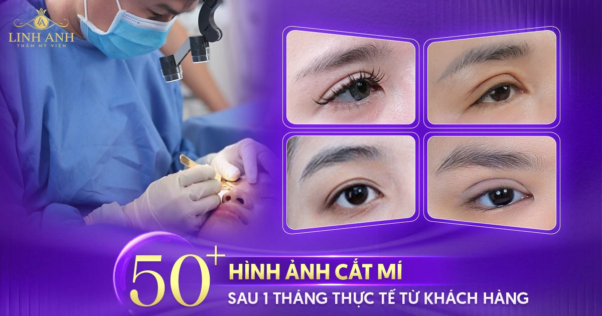hình ảnh cắt mí sau 1 tháng