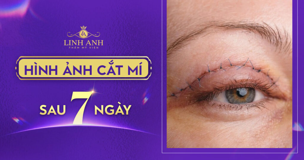 hình ảnh cắt mí sau 7 ngày