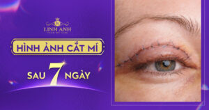 hình ảnh cắt mí sau 7 ngày