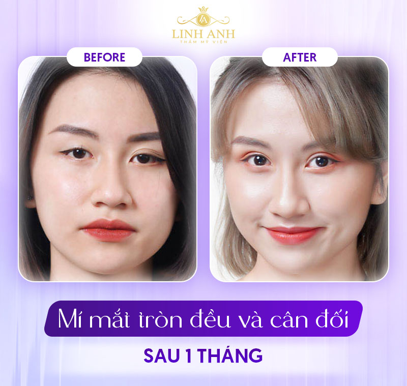 hình ảnh thực tế cắt mí sau 1 tháng hình ảnh thực tế cắt mí sau 1 tháng