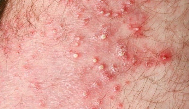 hình ảnh viêm chân lông vùng kín hình ảnh viêm chân lông vùng kín