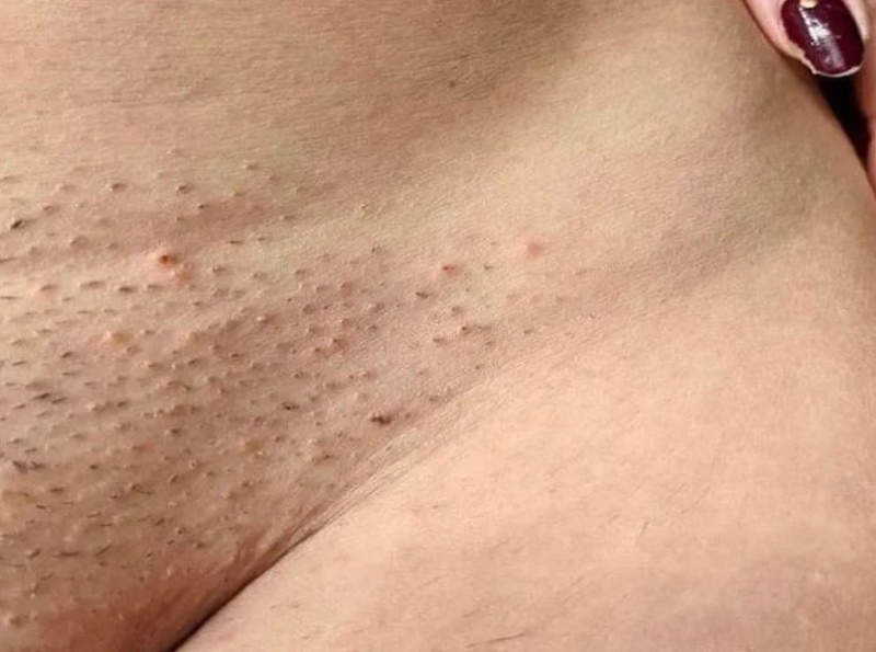 hình ảnh viêm lỗ chân lông vùng bikini hình ảnh viêm lỗ chân lông vùng bikini