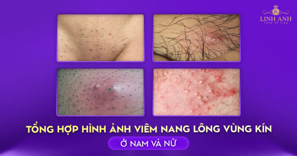 hình ảnh viêm nang lông vùng kín