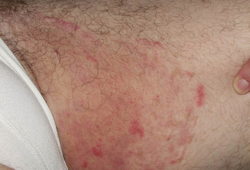 hình ảnh viêm nang lông vùng kín nam hình ảnh viêm nang lông vùng kín nam