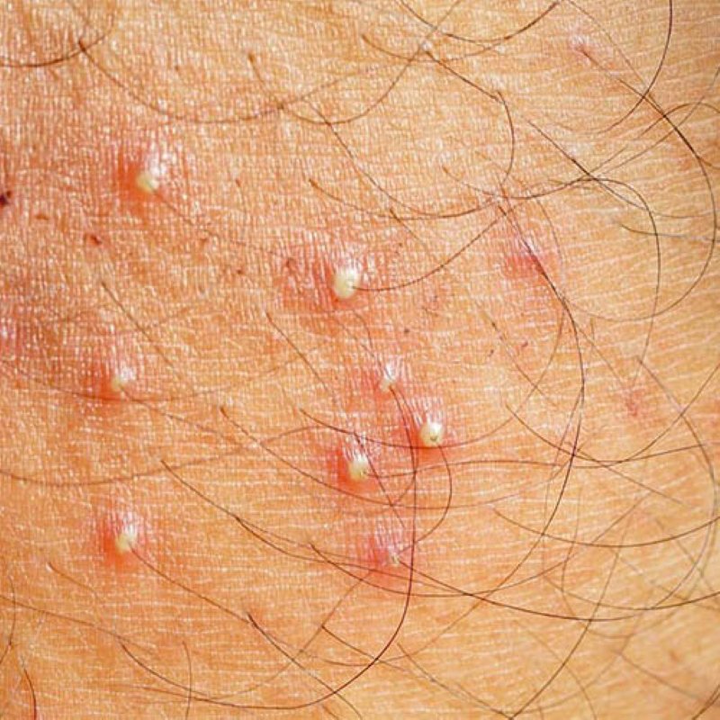 hình ảnh viêm nang lông vùng kín ở nam và nữ hình ảnh viêm nang lông vùng kín ở nam và nữ