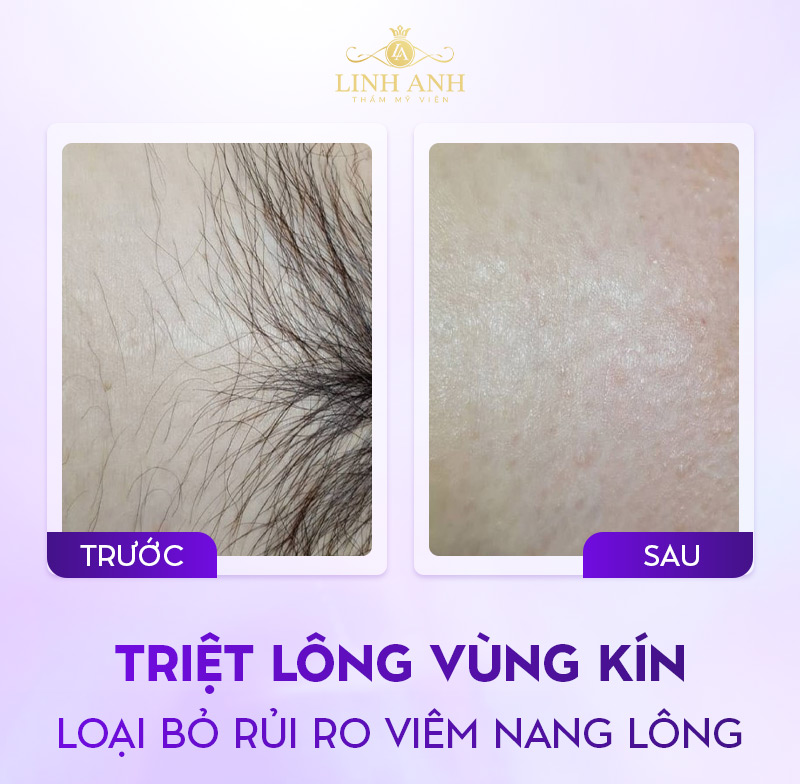 hình ảnh viêm nang lông vùng kín ở nữ hình ảnh viêm nang lông vùng kín ở nữ