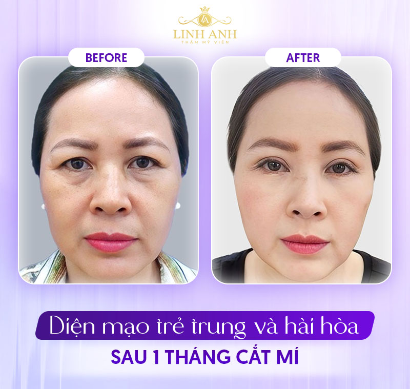 khách hàng cắt mí sau 1 tháng sẽ ra sao khách hàng cắt mí sau 1 tháng sẽ ra sao