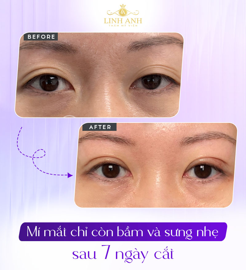 khách hàng cắt mí sau 7 ngày sẽ ra sao khách hàng cắt mí sau 7 ngày sẽ ra sao