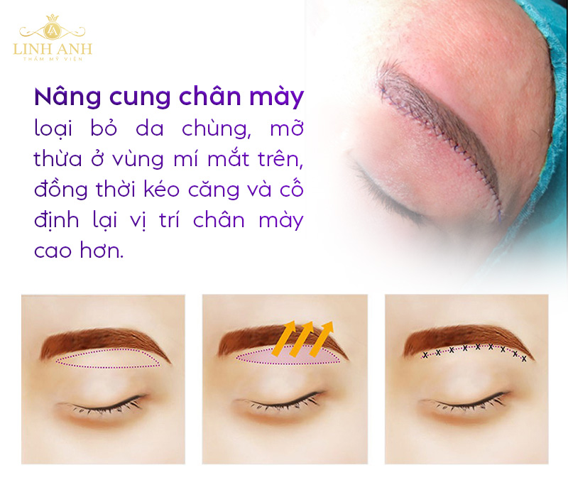 nâng cung mày có nhược điểm gì nâng cung mày có nhược điểm gì