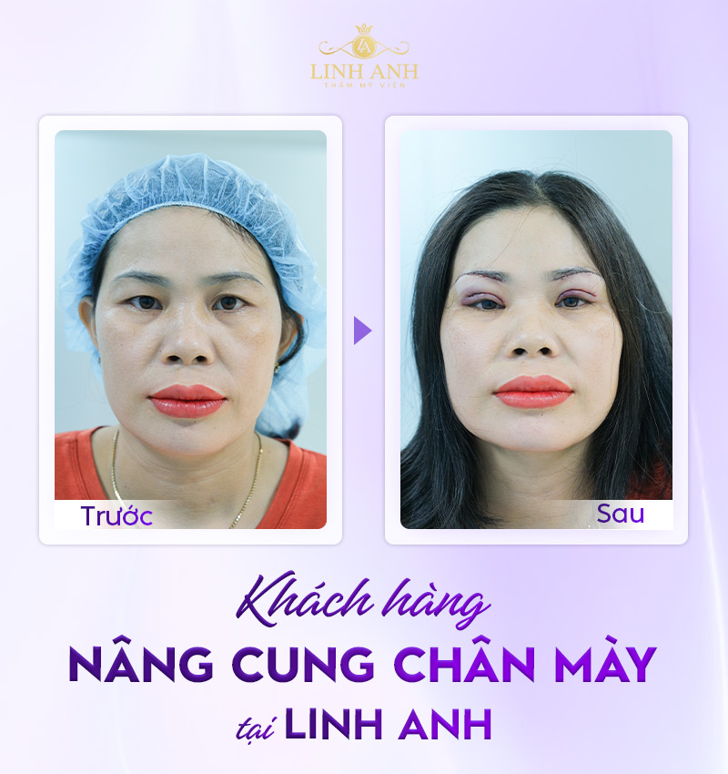 nâng cung mày tiềm tàng rủi ro gì nâng cung mày tiềm tàng rủi ro gì