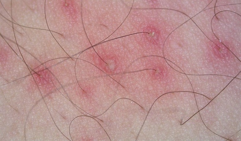 những hình ảnh viêm lỗ chân lông vùng bikini những hình ảnh viêm lỗ chân lông vùng bikini