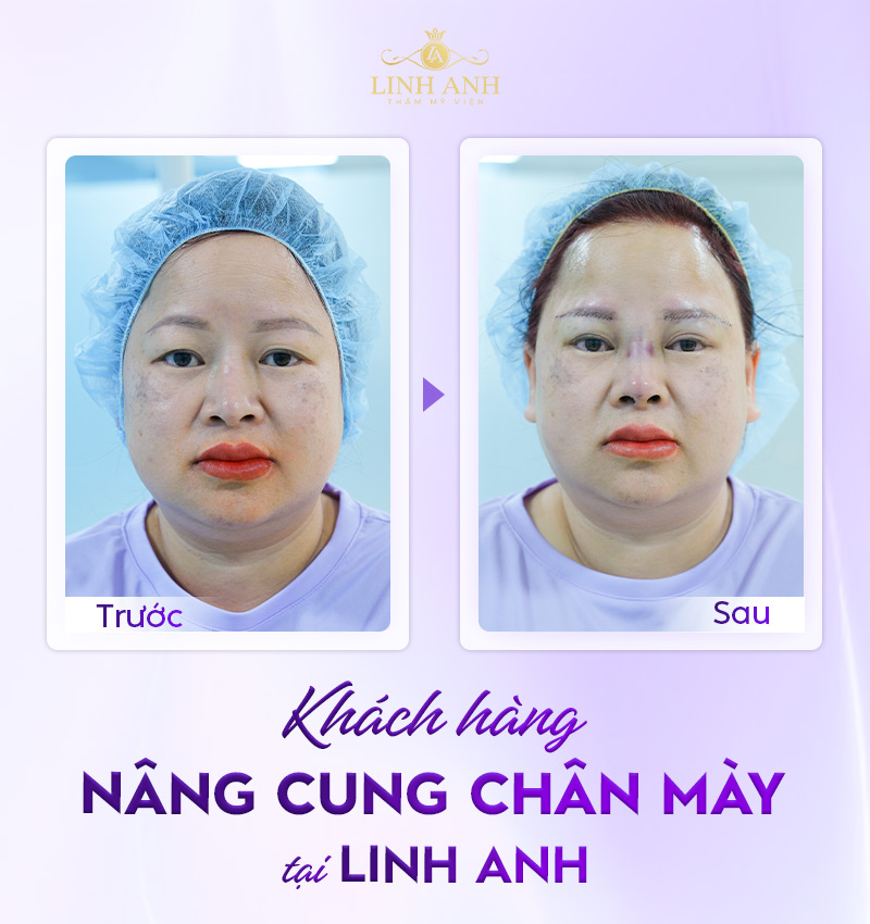 những nhược điểm của nâng cung mày những nhược điểm của nâng cung mày