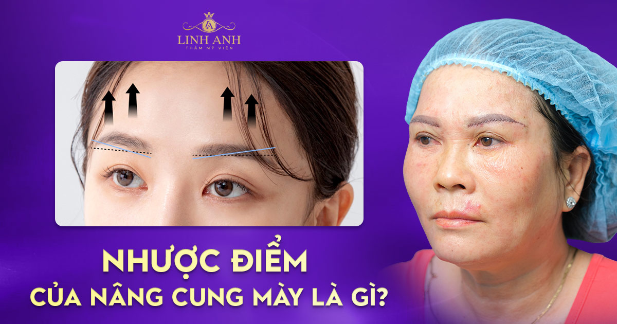 Nhược điểm của nâng cung mày là gì? Có nên nâng cung mày không?