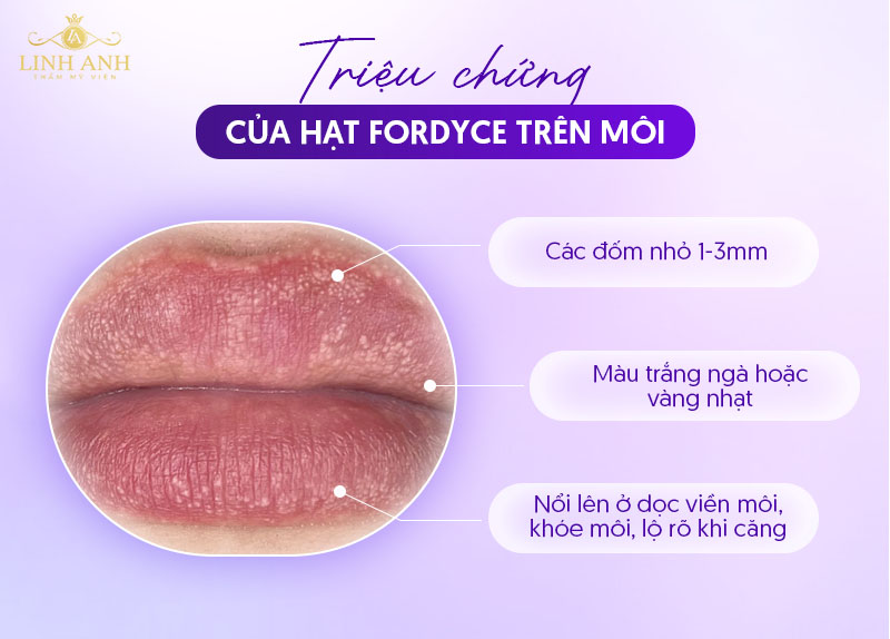 Nổi hạt fordyce trên mụn trắng ở môi Nổi hạt fordyce trên mụn trắng ở môi