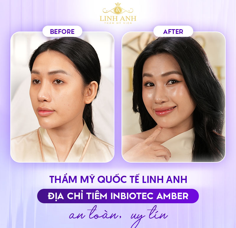 Tiêm Inbiotec Amber tại Linh Anh