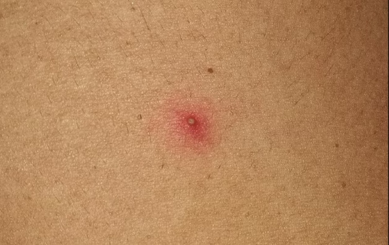 viêm nang lông vùng kín ra sao viêm nang lông vùng kín ra sao