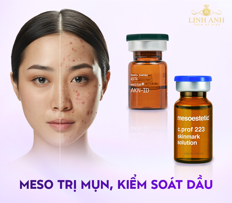 Tiêm Meso loại nào tốt Tiêm Meso loại nào tốt