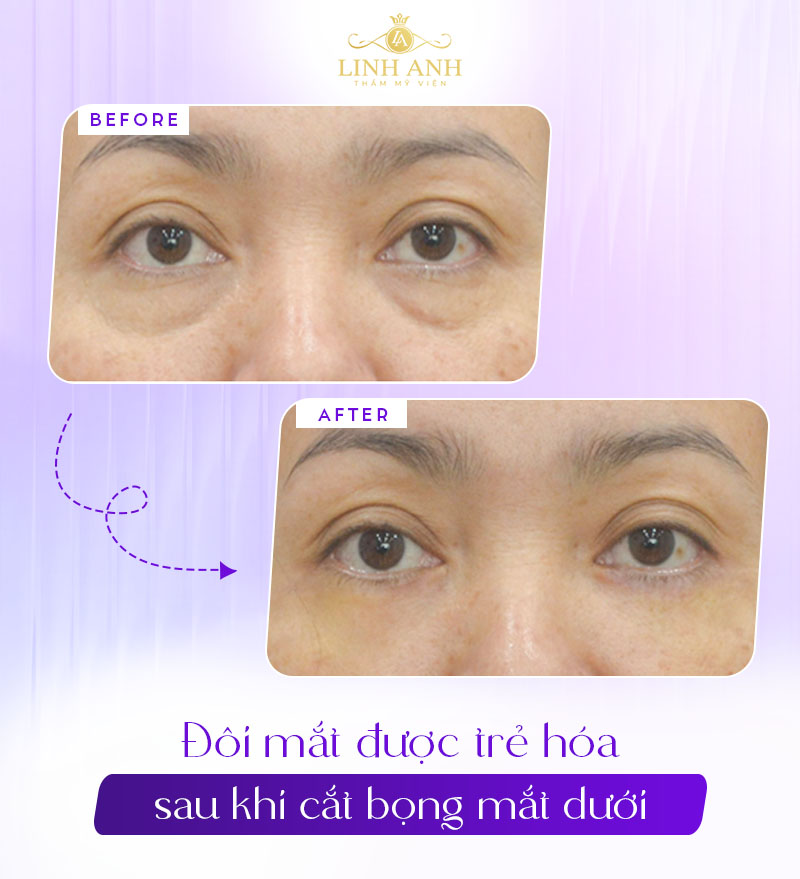 ảnh bọng mắt dưới vừa mới cắt xong ảnh bọng mắt dưới vừa mới cắt xong