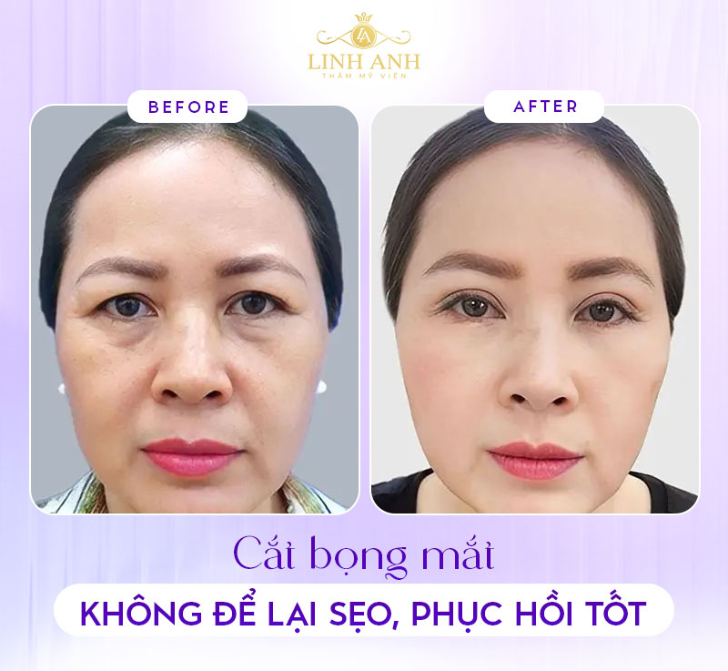ảnh sau khi cắt bọng mắt dưới từ khách hàng ảnh sau khi cắt bọng mắt dưới từ khách hàng