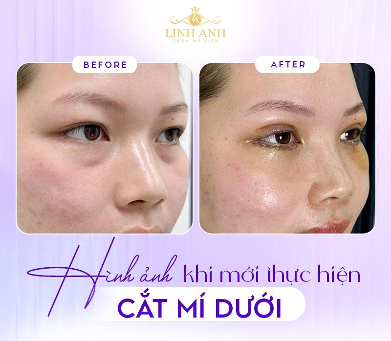 ảnh sau khi cắt bọng mắt dưới ảnh sau khi cắt bọng mắt dưới