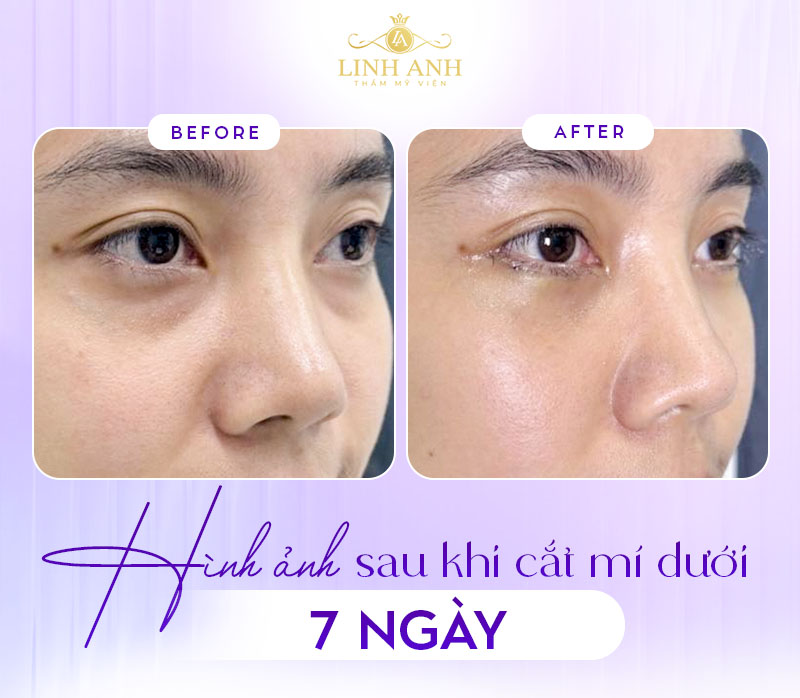 ảnh sau khi cắt mỡ bọng mắt dưới ảnh sau khi cắt mỡ bọng mắt dưới