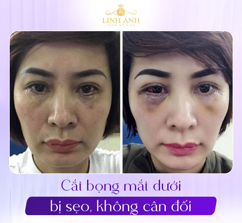 ảnh sau khi lấy mỡ bọng mắt dưới ảnh sau khi lấy mỡ bọng mắt dưới