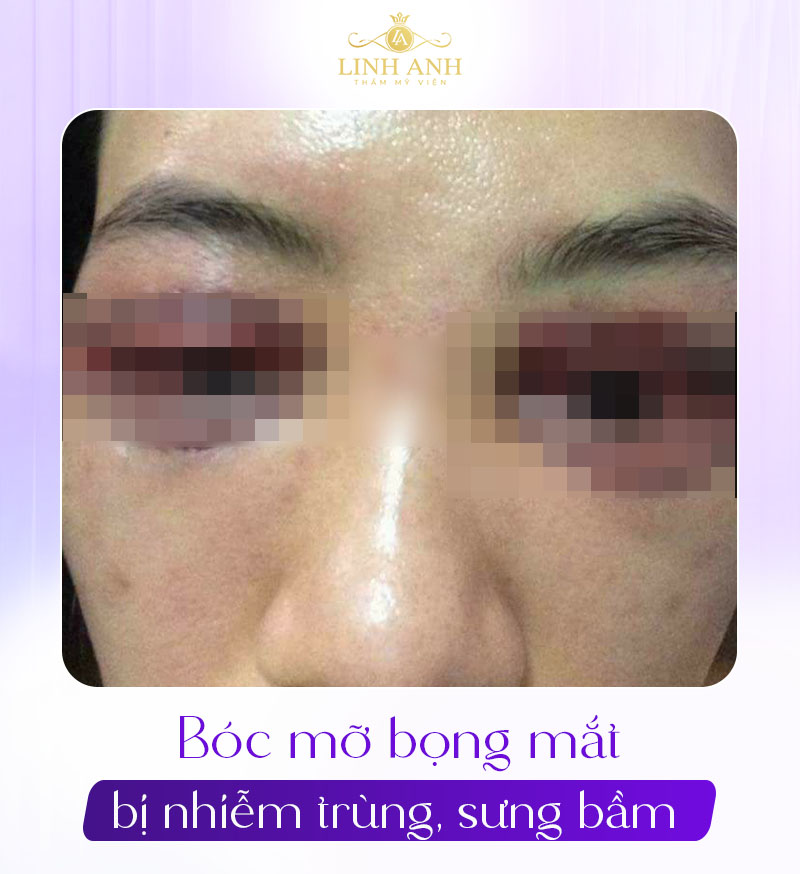 ảnh thực tế sau khi cắt bọng mắt dưới ảnh thực tế sau khi cắt bọng mắt dưới