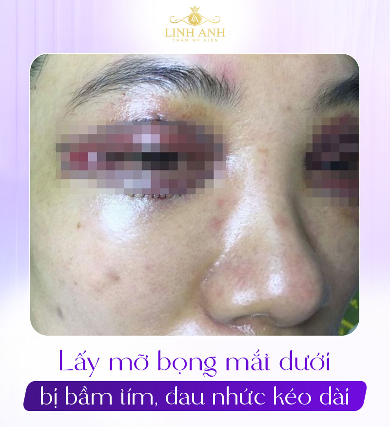 ảnh thực tế sau khi lấy mỡ bọng mắt dưới ảnh thực tế sau khi lấy mỡ bọng mắt dưới