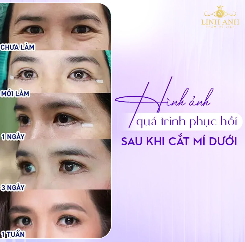 bọng mắt dưới cắt xong sẽ ra sao bọng mắt dưới cắt xong sẽ ra sao