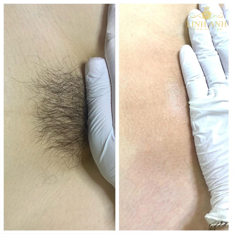 cách triệt lông vùng kín tạo hình giọt nước cách triệt lông vùng kín tạo hình giọt nước