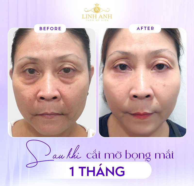 cắt bọng mắt dưới xong sẽ ra sao cắt bọng mắt dưới xong sẽ ra sao