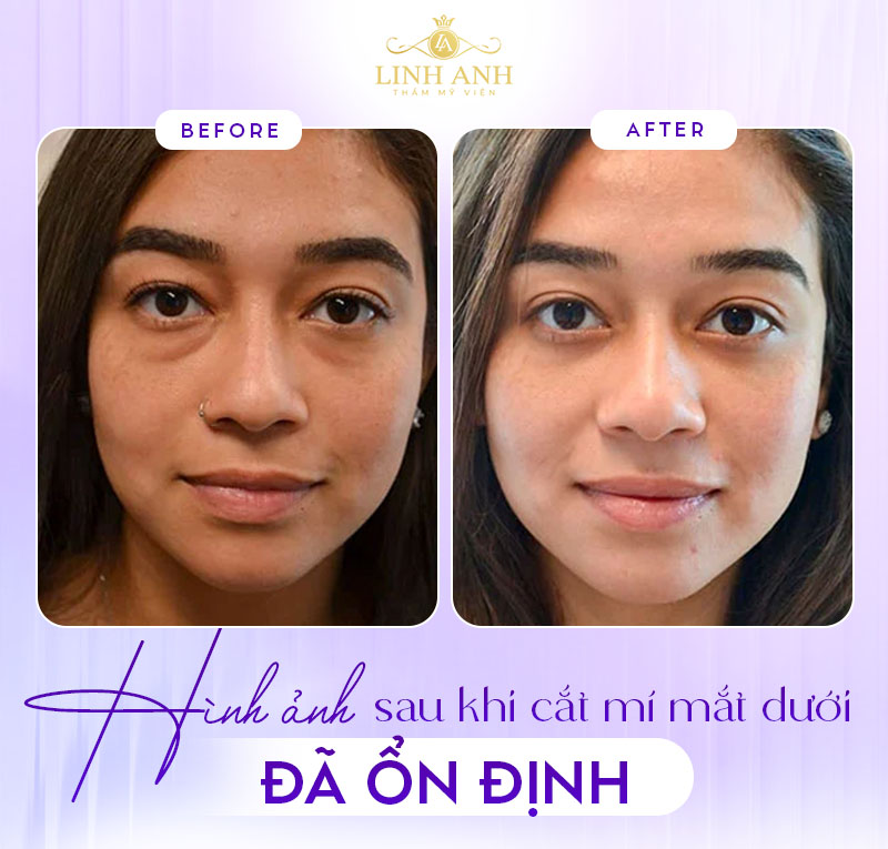 cắt mỡ bọng mắt dưới xong sẽ ra sao cắt mỡ bọng mắt dưới xong sẽ ra sao