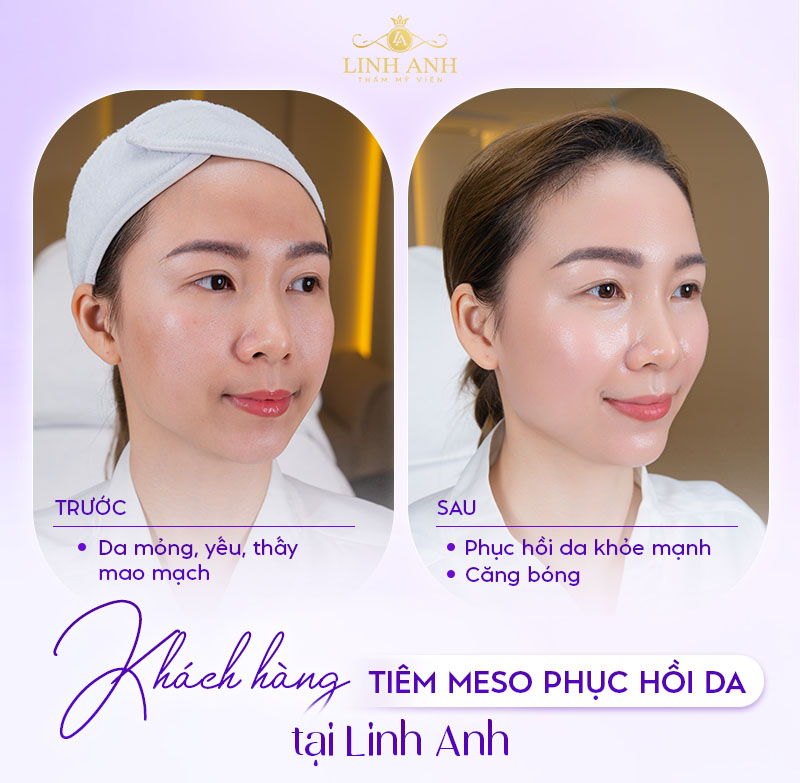 chi phí tiêm mesotherapy phục hồi da chi phí tiêm mesotherapy phục hồi da