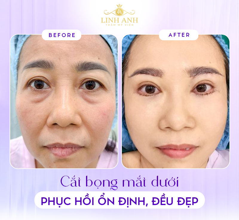 chi tiết ảnh sau khi cắt bọng mắt dưới chi tiết ảnh sau khi cắt bọng mắt dưới