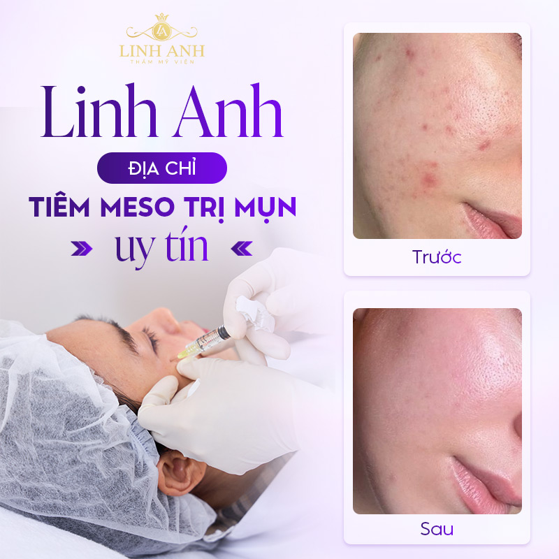 Địa chỉ Tiêm meso trị mụn Địa chỉ Tiêm meso trị mụn