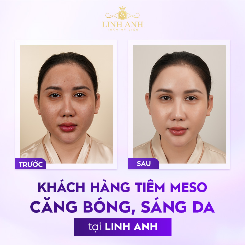 địa chỉ tiêm mesotherapy uy tín địa chỉ tiêm mesotherapy uy tín