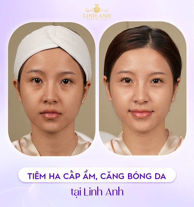 Dịch vụ tiêm meso tại Linh Anh