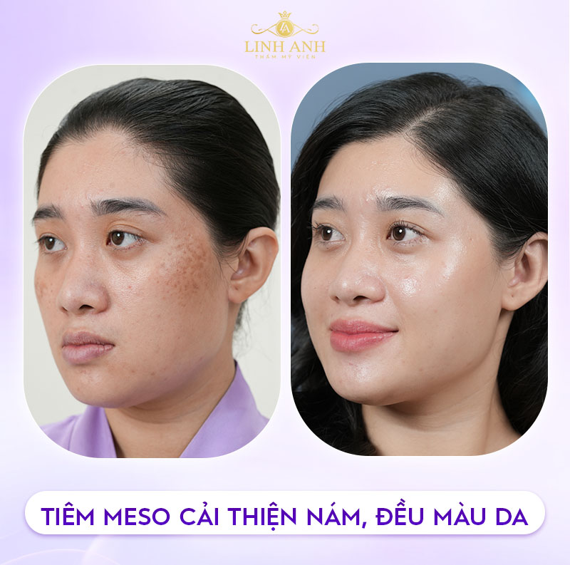 Dịch vụ tiêm meso trị nám tại Linh Anh
